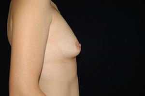 Breast Augmentation 1c